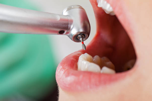 Best Knocked-Out Tooth (Avulsed Tooth) Treatment in Palmer Lake, CO